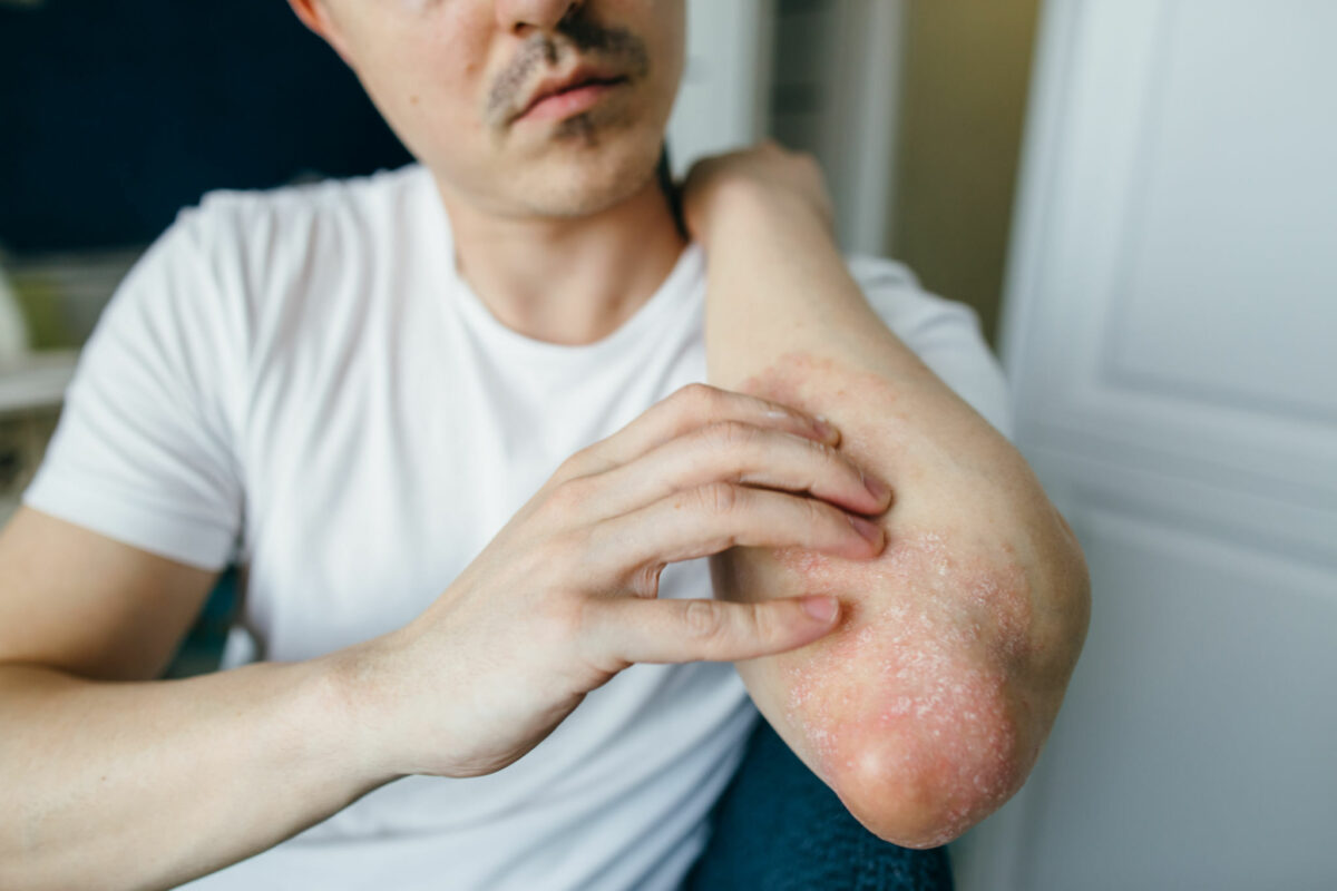 how-to-cure-fungal-infection-on-skin-liveandfeel